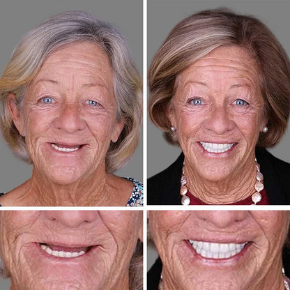 --Ends Today: 75% OFF! ⏰DarkFairy™ Medical Full Denture with Strong Suctiond Custom-Fit Full Functional Dentures🦷