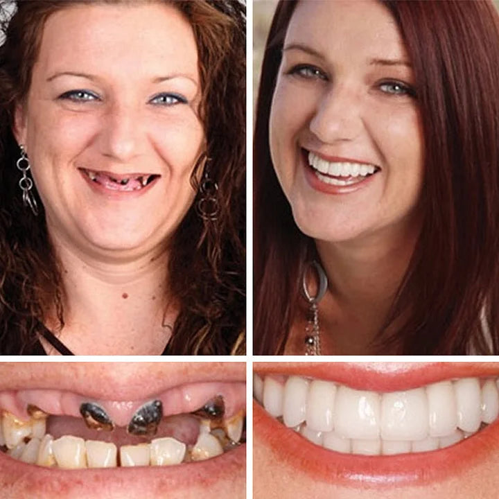 --Ends Today: 75% OFF! ⏰DarkFairy™ Medical Full Denture with Strong Suctiond Custom-Fit Full Functional Dentures🦷